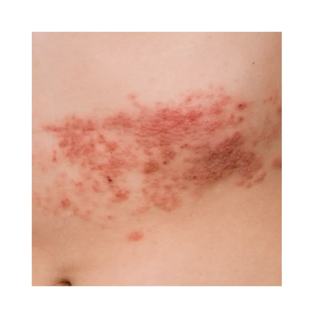 esta página mostra parte da barriga de uma pessoa infectada com a herpes zoster em referencia ao artigo Herpes Zoster em Idosos: Quando Vacinar e Como Cuidar Após a Infecção
