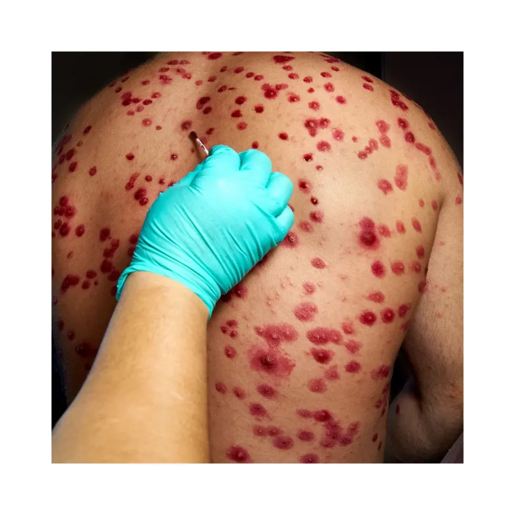 esta página mostra as costas de um pessoa totalmente infectada pela herpes zoster em  referência ao artigo  Herpes Zoster em Idosos: Quando Vacinar e Como Cuidar Após a Infecção